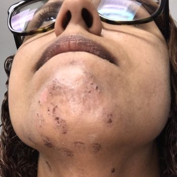 Body Details - Burned by laser - Laser Hair Removal Near Me - Boca Raton, Florida Body Details - Burned by laser - Laser Hair Removal Near Me - Boca Raton, Florida