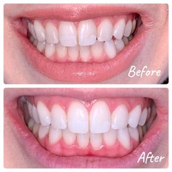 White Teeth Co