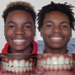 Team Orthodontics - This smile was completed by using traditional, metal brackets for approximately 2 years. We're Your Family Orthodontist!
