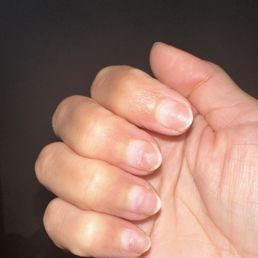 My nails still healing looking ugly but 1.5 months later of continuous oils and creams expensive buying special oils and creams for them.