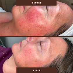 Freya Medispa & Wellness - Visible redness reduced, skin calmed! Freya's rosacea treatments deliver real results. Book your free consult today.