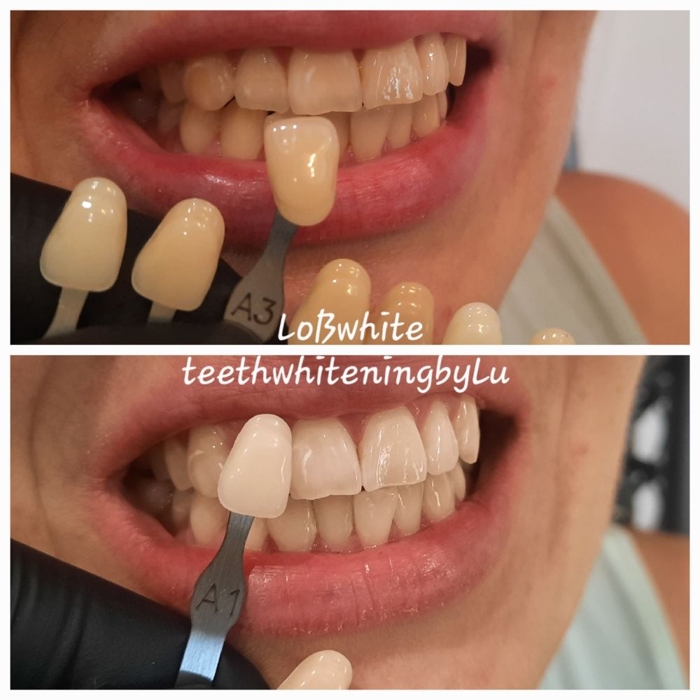 LOB WHITE 28 Photos Los Angeles, California Teeth Whitening