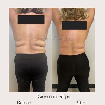Giovanni Med Spa - Before and after - Medical Spas Near Me - Gilbert, Arizona Giovanni Med Spa - Before and after - Medical Spas Near Me - Gilbert, Arizona