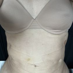 The Falcone Center - 2 weeks post op
