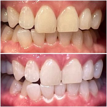 Deebeaut - Teeth Whitening Near Me