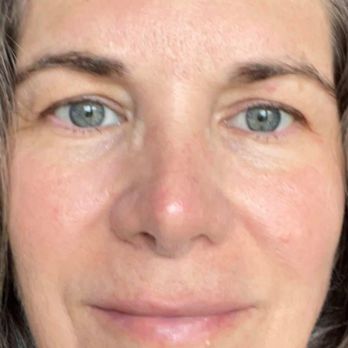 Ivan Vrcek, MD - Photo taken last fall at same window with same lighting as next photo taken today. - Cosmetic Surgeons Near Me - Dallas, Texas Ivan Vrcek, MD - Photo taken last fall at same window with same lighting as next photo taken today. - Cosmetic Surgeons Near Me - Dallas, Texas