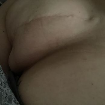 Ronald F Rosso, MD - Breast implant sooo ugly - Cosmetic Surgeons Near Me - Torrance, California Ronald F Rosso, MD - Breast implant sooo ugly - Cosmetic Surgeons Near Me - Torrance, California