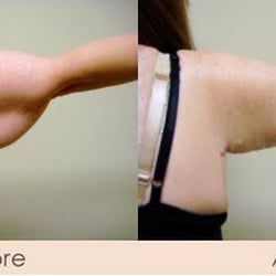 Michael Gray and Skindeep Spa - Arm Tuck - Posterior Incision