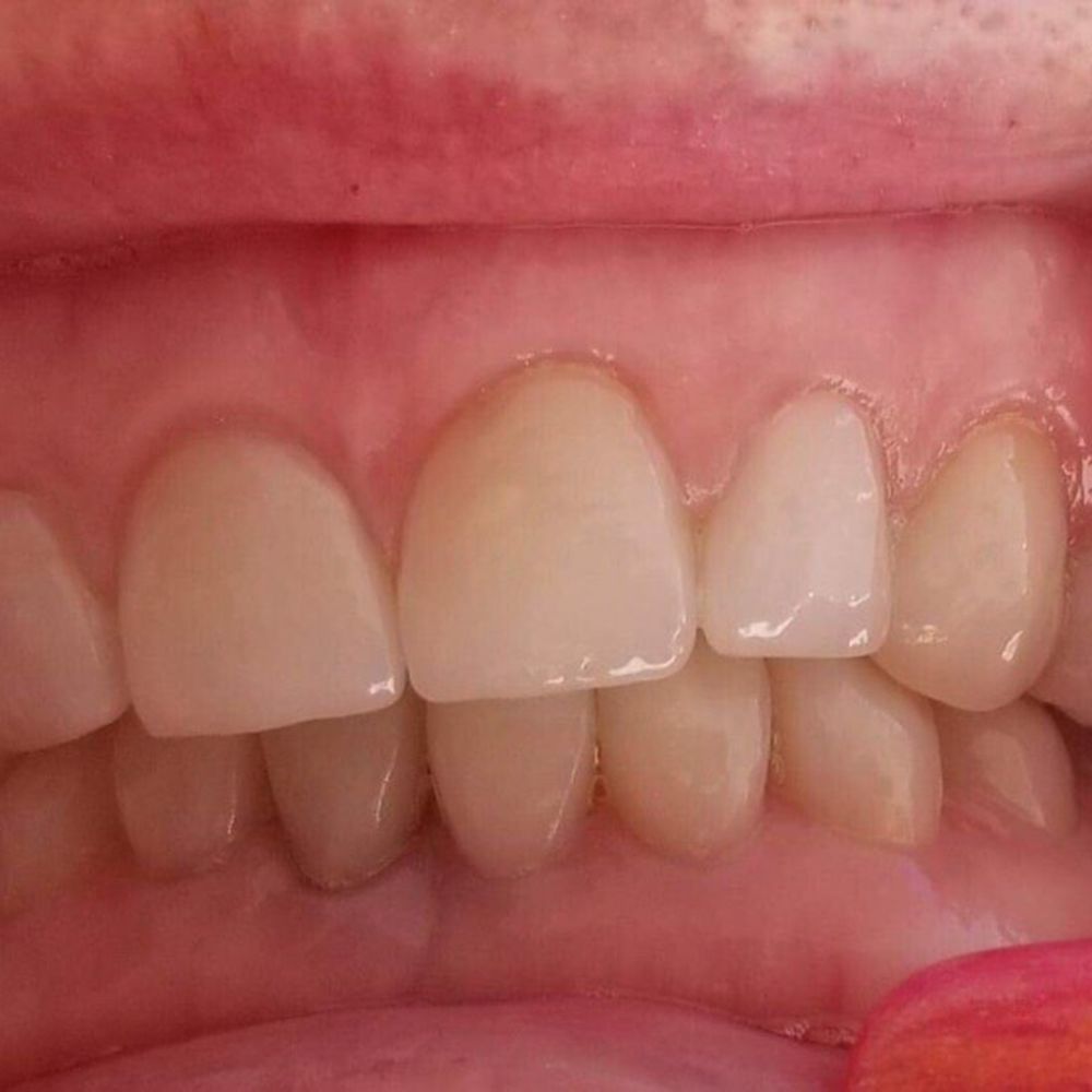 Just Smiles - 8ea top veneers - Hospitals Near Me - Puerto Vallarta, JAL Just Smiles - 8ea top veneers - Hospitals Near Me - Puerto Vallarta, JAL