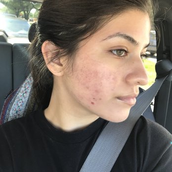 Dr Bouyarden Center - BEFORE. I had just got a chemical peel done. I know it looks bad but looks great now! The process took a while but was definitely worth it. - Medical Spas Near Me - Bellaire, Texas Dr Bouyarden Center - BEFORE. I had just got a chemical peel done. I know it looks bad but looks great now! The process took a while but was definitely worth it. - Medical Spas Near Me - Bellaire, Texas