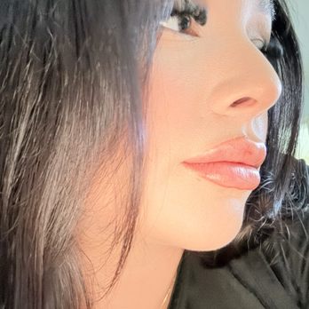 Deia Aesthetic Studio - Lip & chin filler. - Medical Spas Near Me - Torrance, California