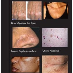 The Hague Medi-Spa - Skin Classic Lesion Removal