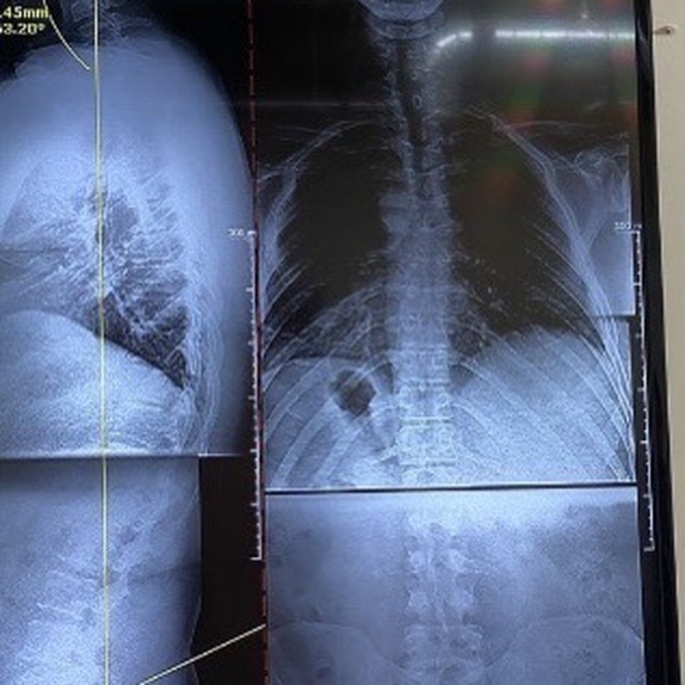 Full spine x-ray from my chiropractor