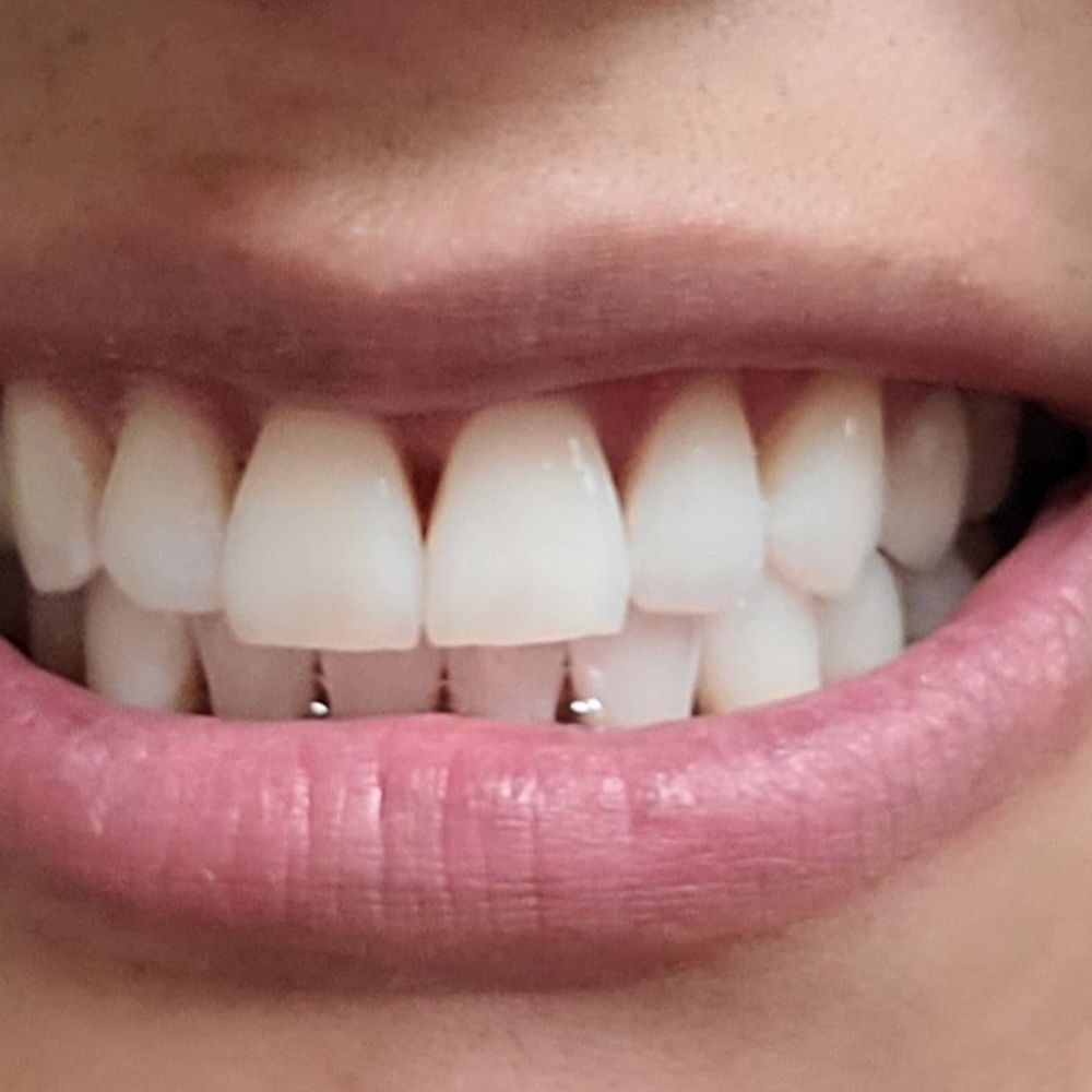 BEFORE AND AFTER. The tooth on my right is my shade before. BEFORE AND AFTER. The tooth on my right is my shade before.