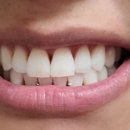 BEFORE AND AFTER. The tooth on my right is my shade before. BEFORE AND AFTER. The tooth on my right is my shade before.