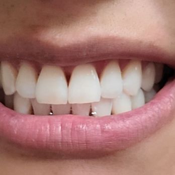 Care Dental - BEFORE AND AFTER. The tooth on my right is my shade before. - General Dentistry Near Me - Moorpark, California Care Dental - BEFORE AND AFTER. The tooth on my right is my shade before. - General Dentistry Near Me - Moorpark, California