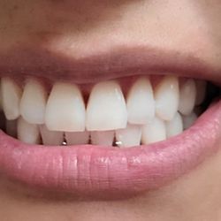 BEFORE AND AFTER. The tooth on my right is my shade before.
