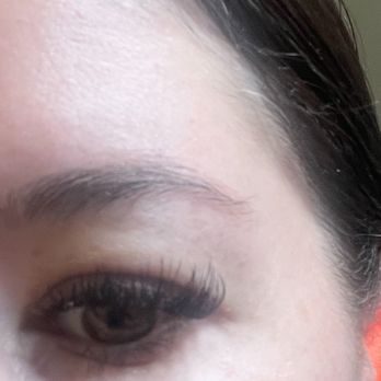 Spa Trouvé - This is after the PRP. I will now have to get reconstructive surgery to fix the damage that they have done. - Medical Spas Near Me - Draper, Utah