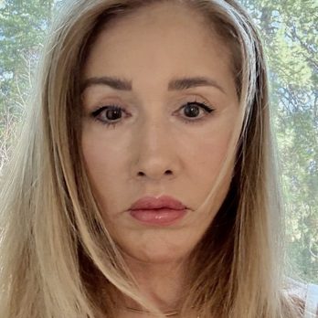 Kevin Sadati - Every day gets better! 4 weeks post op - Cosmetic Surgeons Near Me - Newport Beach, California