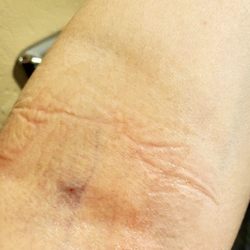 Quest Diagnostics - Busted swollen vein