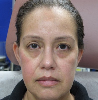 Getting rid of the tired eye look. Under eye filler. - Tear trough deficiency is a complex area to fill. The skin is thin and the wrong filler placed there can cause a bluish discoloration or a tendal effect. If not placed deep under the obicularis muscle, it can appear as lumpy. If placed superfically it must have a cohesive property where it spreads. Fillers that are extremely hydrophilic that absorb water will cause bags under the eyes. If filler is placed incorrectly, it can also impede the lympatics of the eye and cause swelling. That being said, it is one of my favorite areas to correct. I exclusively, use cannulas here. Getting rid of the tired eye look. Under eye filler. - Tear trough deficiency is a complex area to fill. The skin is thin and the wrong filler placed there can cause a bluish discoloration or a tendal effect. If not placed deep under the obicularis muscle, it can appear as lumpy. If placed superfically it must have a cohesive property where it spreads. Fillers that are extremely hydrophilic that absorb water will cause bags under the eyes. If filler is placed incorrectly, it can also impede the lympatics of the eye and cause swelling. That being said, it is one of my favorite areas to correct. I exclusively, use cannulas here.
