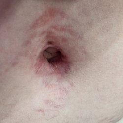 James Nachbar, MD, FACS - Belly button 4 months post op