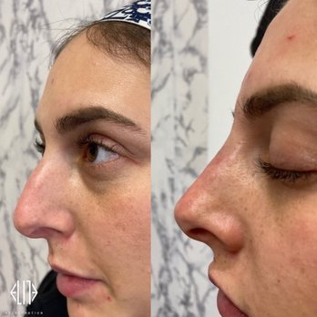 Elite Rejuvenation - Nose filler. - IV Hydration Near Me - Boca Raton, Florida Elite Rejuvenation - Nose filler. - IV Hydration Near Me - Boca Raton, Florida