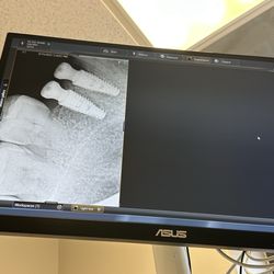 Smile Design Santa Clarita - The first two are healing nicely, two more to go then my crowns.