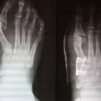Lawrence Silverberg, DPM - Before and After - Podiatrists Near Me - New York, New York Lawrence Silverberg, DPM - Before and After - Podiatrists Near Me - New York, New York