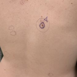 Cumberland Skin Surgery & Dermatology - Hermitage - Moles marked for removal and skin tags. The red dots are angiomas + need lasered off, but I'm pregnant.