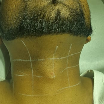 Laser Hair Removal Neck Zero Ingrown Hairs Razor Bumps