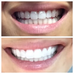 Summit Family Dentistry - Before and after Zoom 1-hr in office teeth whitening