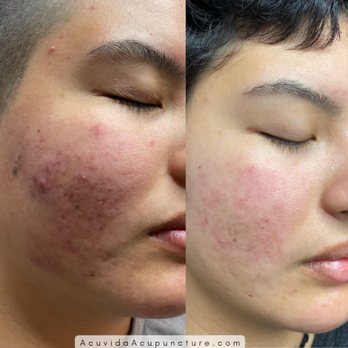 AcuVida Acupuncture - Before and after results of acne treatment. We combined Acupuncture with microneedling. - Acupuncture Near Me - South Pasadena, California AcuVida Acupuncture - Before and after results of acne treatment. We combined Acupuncture with microneedling. - Acupuncture Near Me - South Pasadena, California