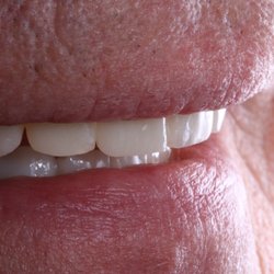 Copp Dental Group - Life like esthetics of the temporaries for a full mouth reconstruction in a physiologic bite position.