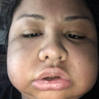 Princessa Dental - Swollen after surgery - Cosmetic Dentists Near Me - Santa Clarita, California Princessa Dental - Swollen after surgery - Cosmetic Dentists Near Me - Santa Clarita, California