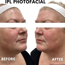 Brilliance Dermatology - IPL photofacials are one of the best ways to get rid of sun damage. Any question - come see Jasmine, our IPL specialist!