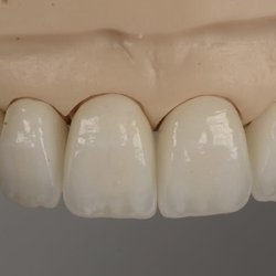 M.I. Dental Designs - Veneers