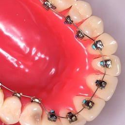HIdden Braces available...your friends won't even know you have braces! HIdden Braces available...your friends won't even know you have braces!