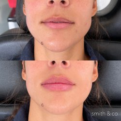 smith & co botox specialist - Best lip fillers in Miami, best Russian lips, beat Botox, best PDO thread lift.