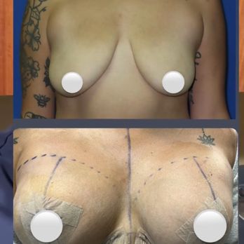 Troy J. Andreasen M.D - pre op vs 1 day post op! - Cosmetic Surgeons Near Me - Bldg #3 Ontario, California Troy J. Andreasen M.D - pre op vs 1 day post op! - Cosmetic Surgeons Near Me - Bldg #3 Ontario, California