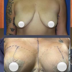 Troy J. Andreasen M.D - Pre op vs 1 day post op!