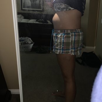 Festus B Dada, MD JD - Side view of swelling after surgery - Surgeons Near Me - Murrieta, California