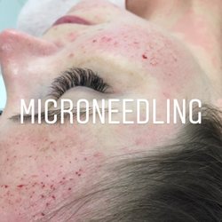 MIA Dental Hygiene - Microneedling