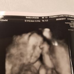 Troche Fertility Centers - Ava Elizabeth at 20 weeks