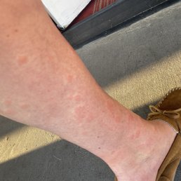 Bedbug bites
