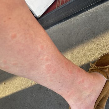 Best Western Willows Inn - Bedbug bites - Hotels Near Me - Willows, California