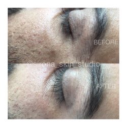 Skin & Body LA - After 1 Facial + RF Treatment