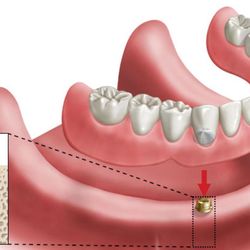 Tim Schankula Denture Clinic - Implant retained dentures