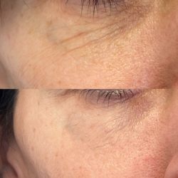 Setiba Medical Spa - Before and after nonsurgical Morpheus8  skin tightening and one plasmapen treatment