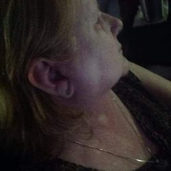 Holland Ear Nose & Throat Assoc - Ear Drum burst and allergic to ear drops